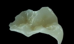 IPS e-max Inlay/Onlay