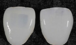FX Veneers