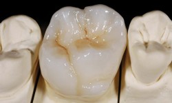 Full Zirconium Crown