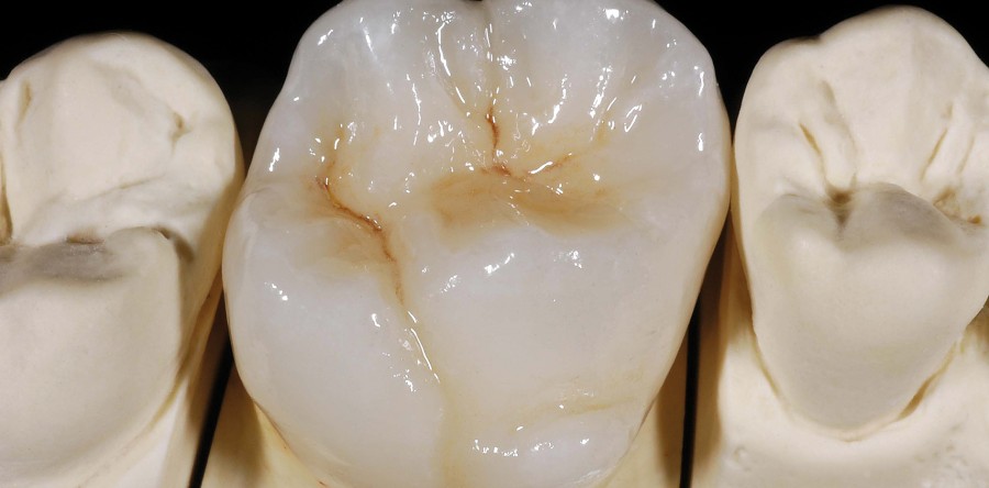 Full Zirconium Crown