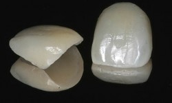 Fx E-max Veneers