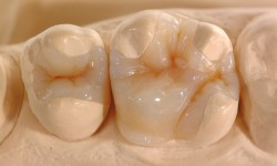 Composite Inlay/Onlay
