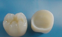 Zirconium layered  Crown